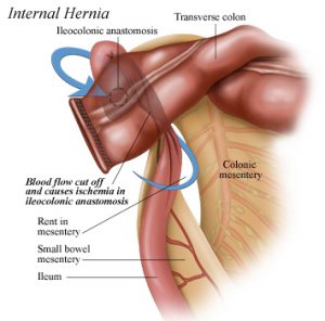 internal hernia